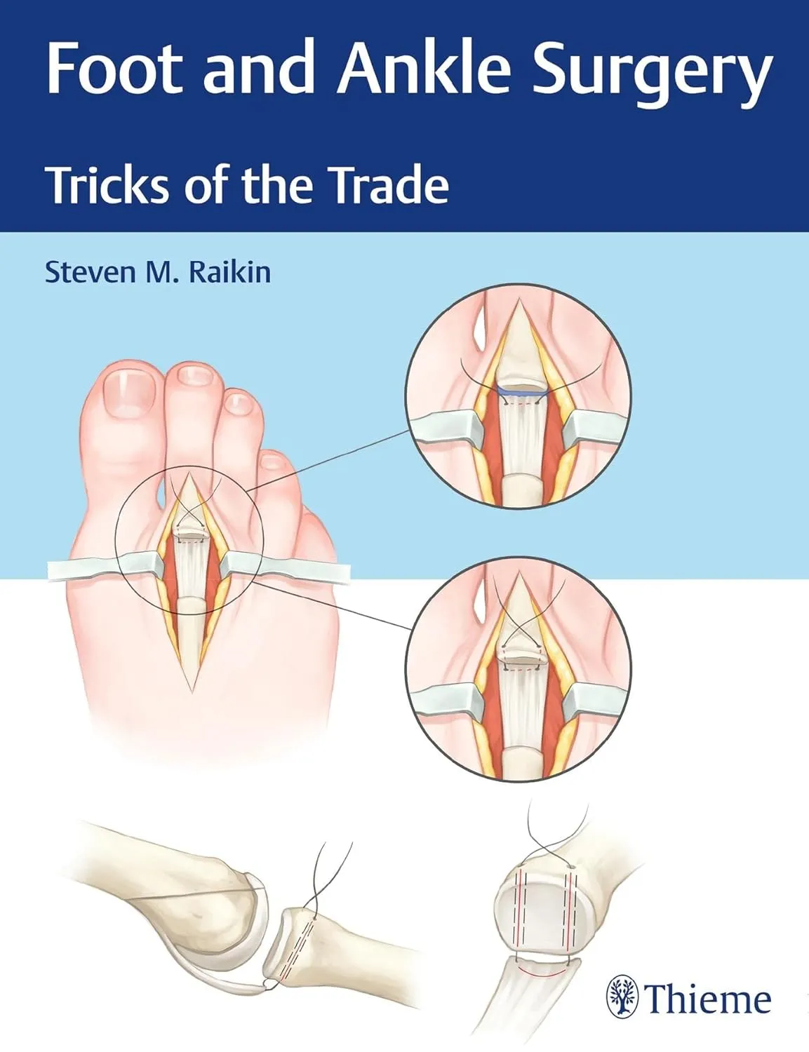 Foot and Ankle Surgery Tricks of the Trade | Hardcover