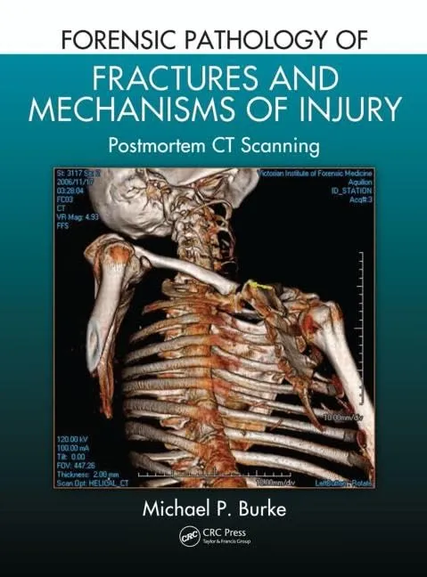 Forensic Pathology of Fractures and Mechanisms of Injury Postmortem CT Scanning | Hardcover