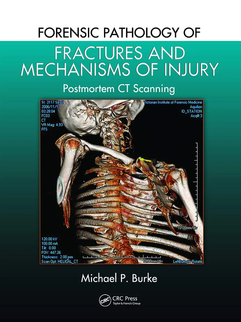 Forensic Pathology Of Fractures And Mechanisms Of Injury Postmortem Ct Scanning | Paperback