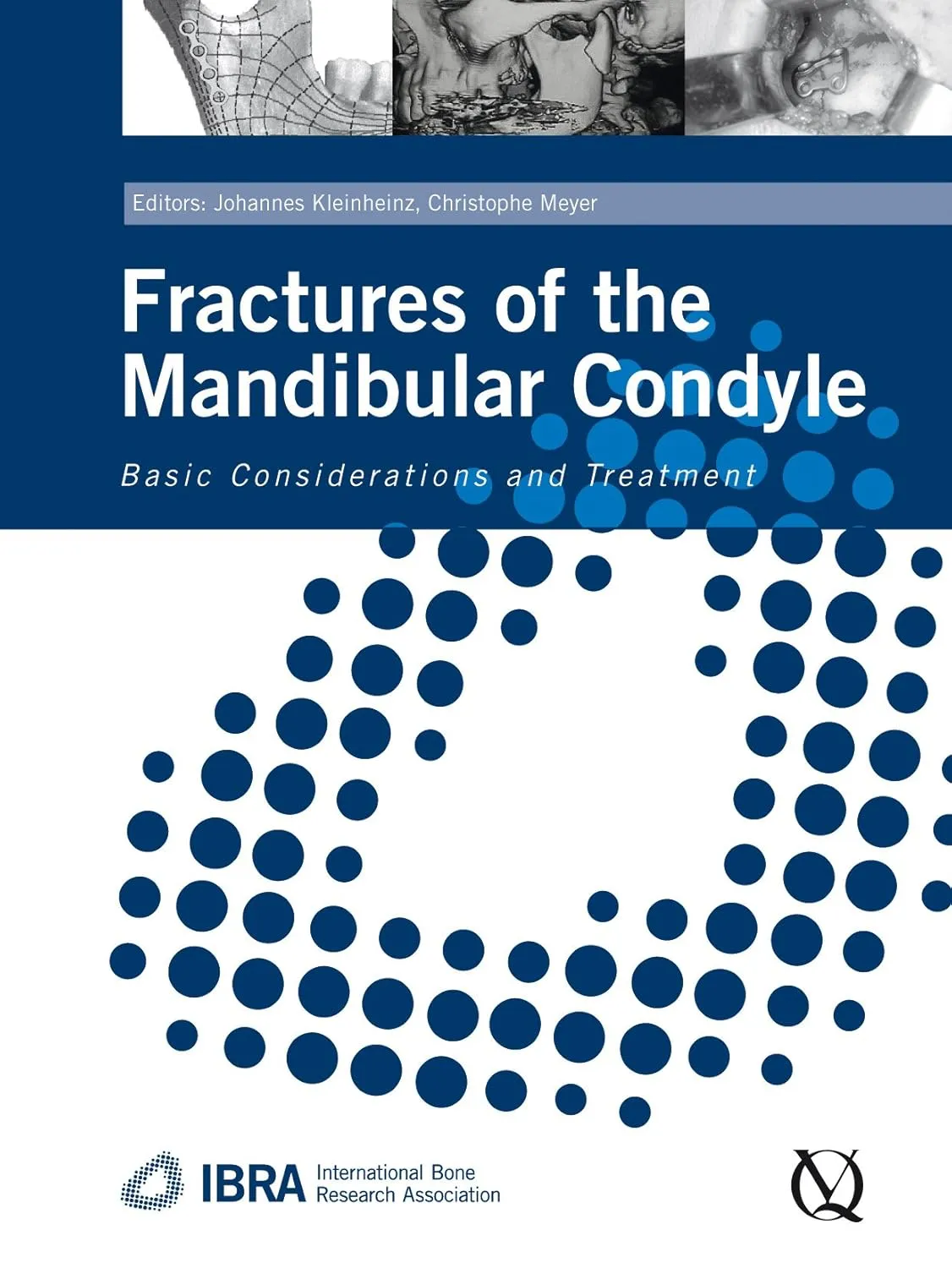 Fractures of the Mandibular Condyle (IBRA) Basic Considerations and Treatment | Hardcover