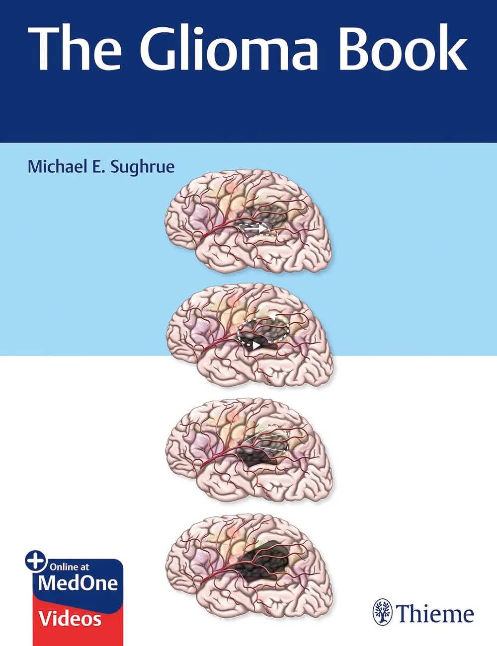 The Glioma Book | Hardcover