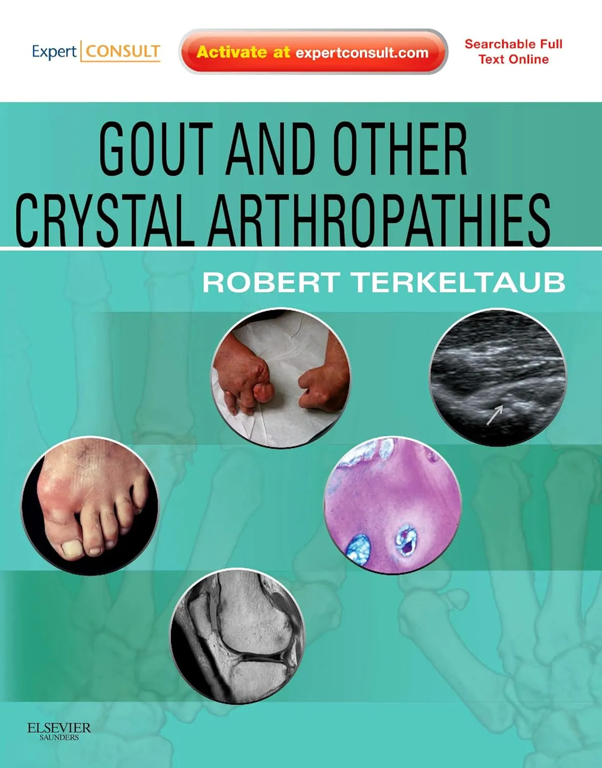 Gout and Other Crystal Arthropathies | Hardcover