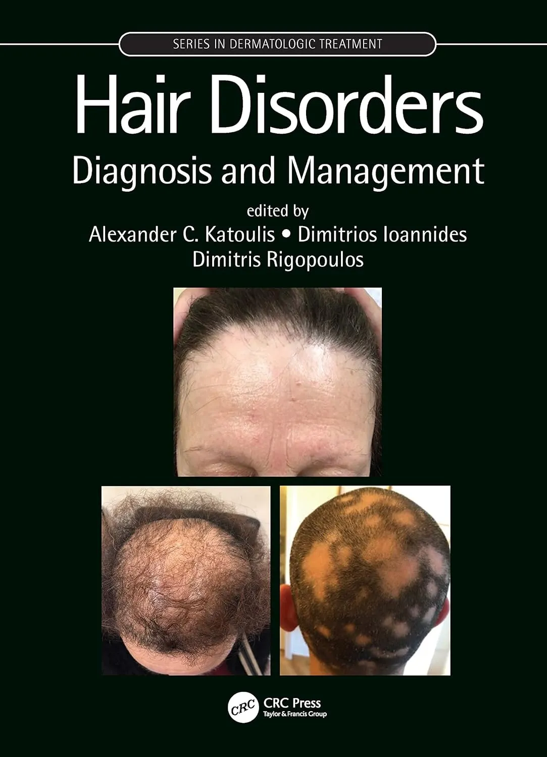 Hair Disorders Diagnosis And Management | Hardcover