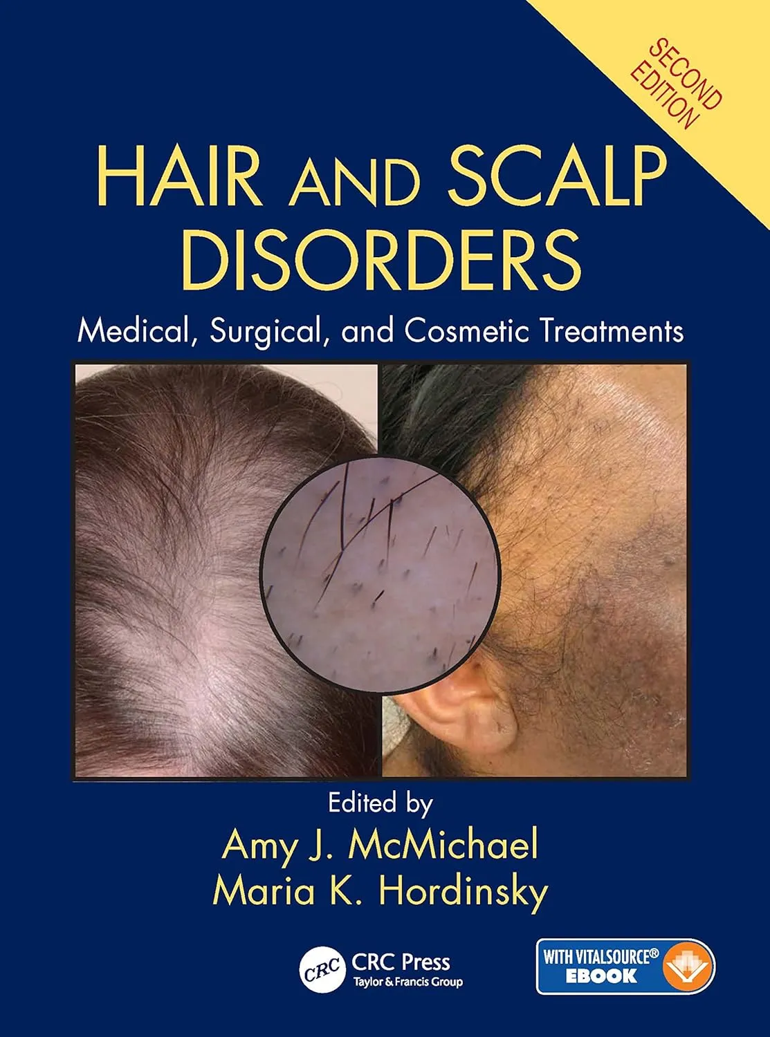 Hair and Scalp Disorders Medical | Surgical and Cosmetic Treatments | 2nd Edition | Hardcover
