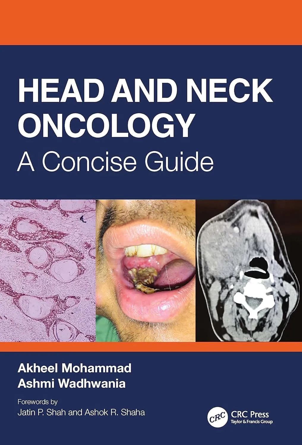 Head And Neck Oncology A Concise Guide | Paperback