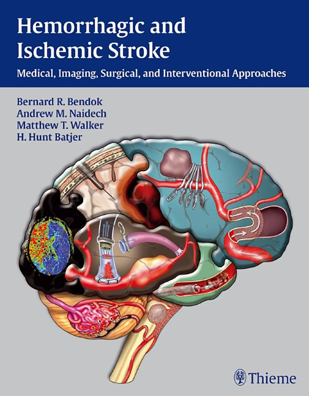 Hemorrhagic and Ischemic Stroke Medical | Imaging | Surgical and Interventional Approaches | Hardcover