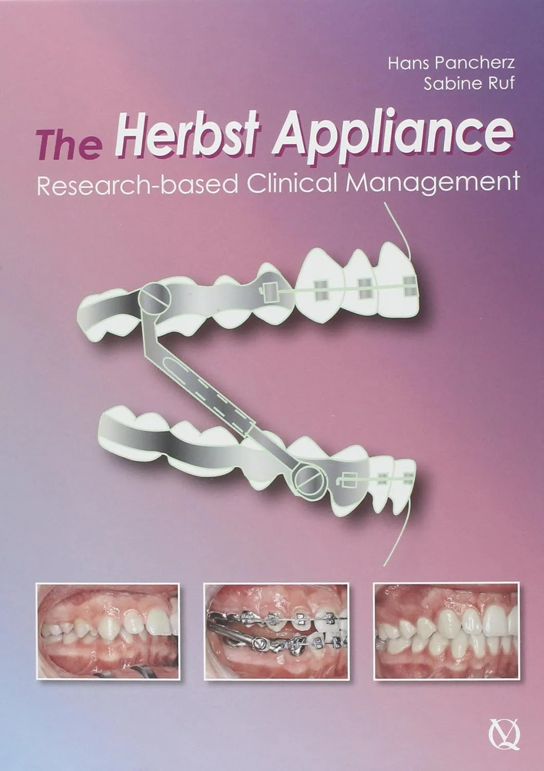 The Herbst Appliance Research Based Clinical Management | Hardcover