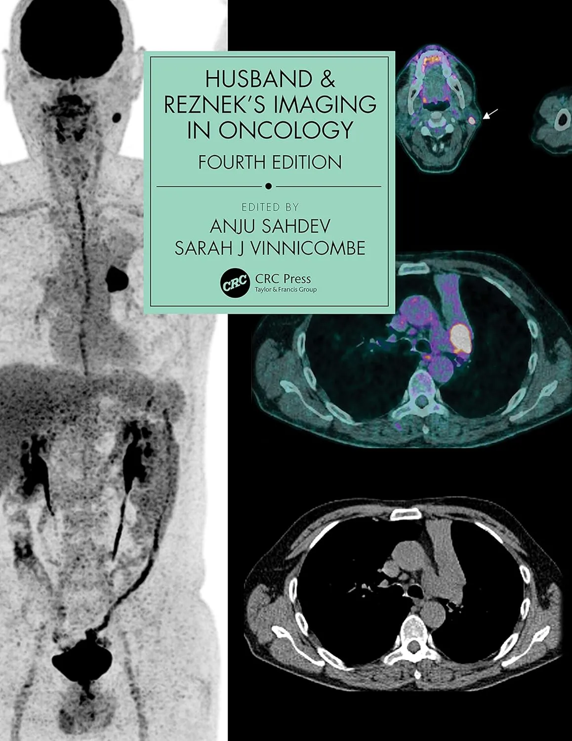 Husband And Rezneks Imaging In Oncology 4th Edition | Hardcover