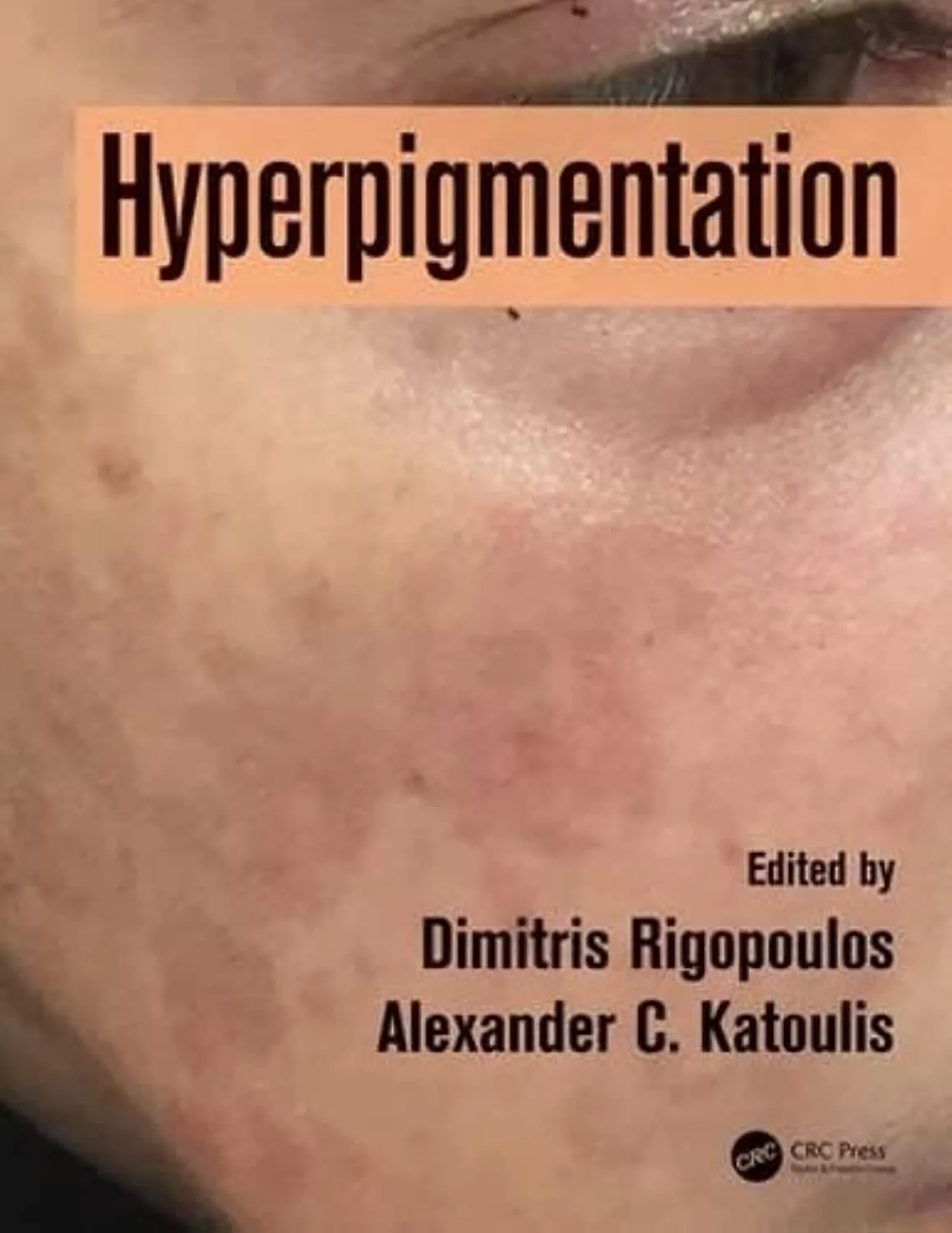 Hyperpigmentation | Hardcover