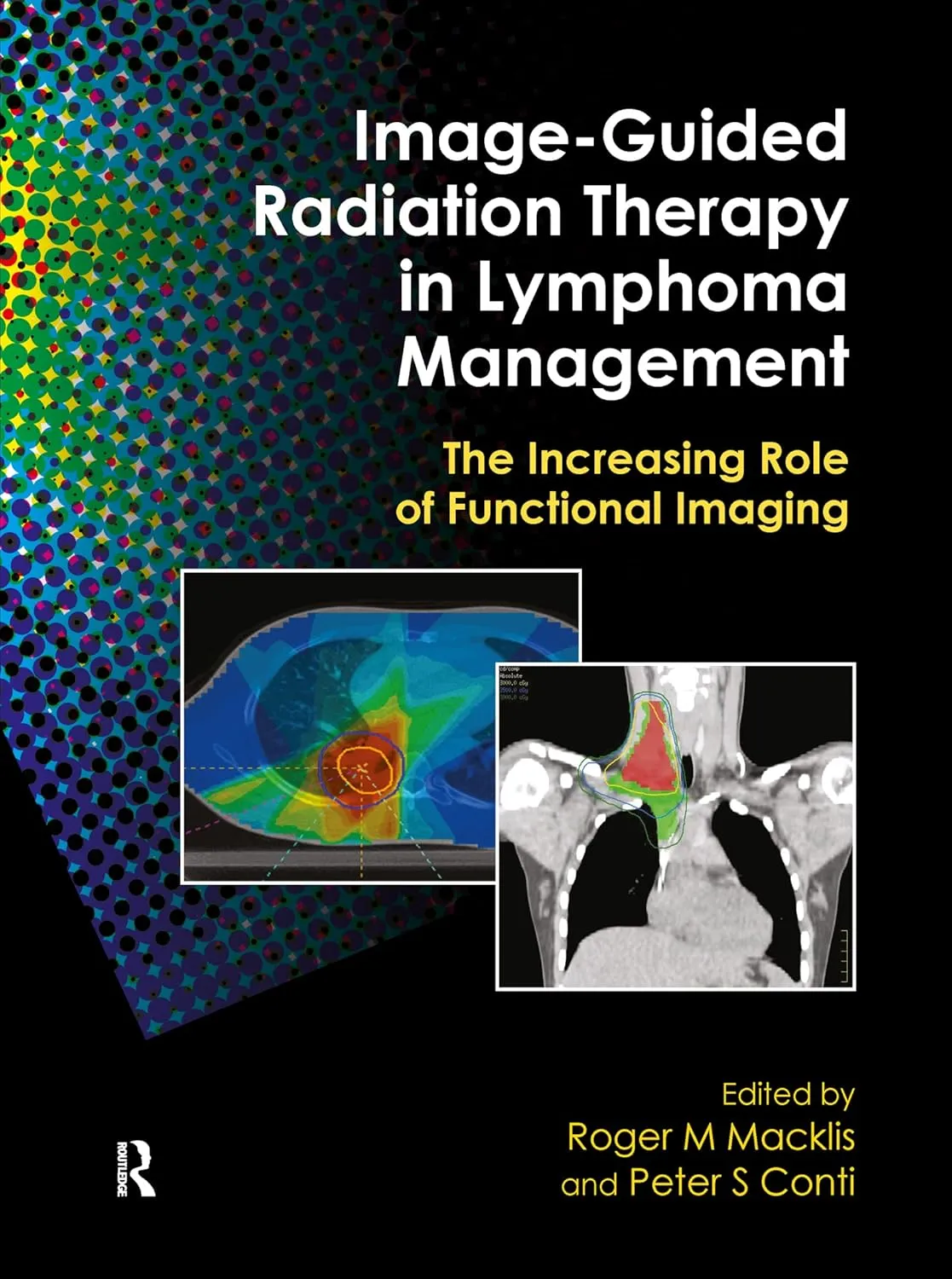 Image-Guided Radiation Theraphy in Lymphoma Management The Increasing Role of Functional Imaging | Hardcover
