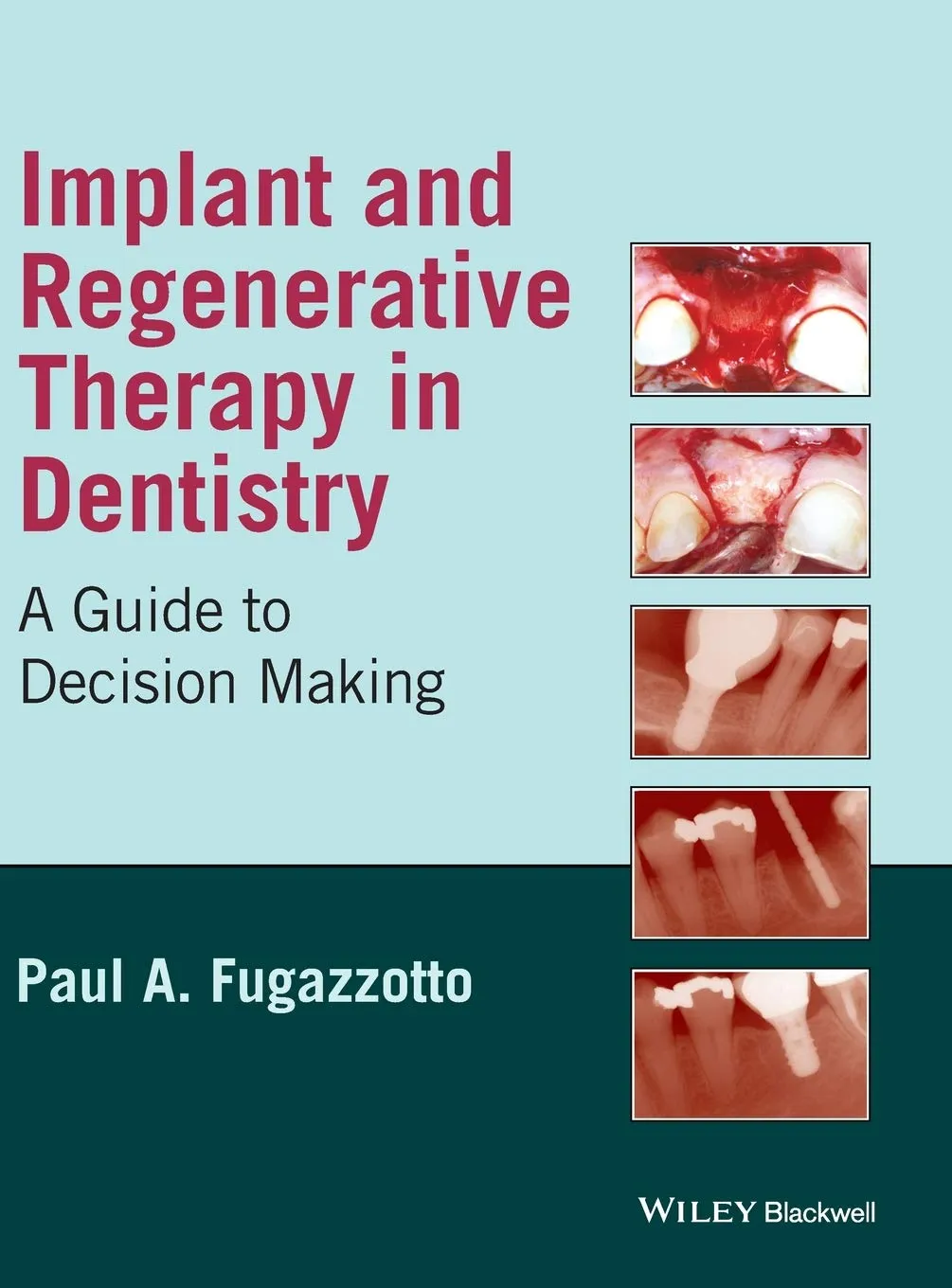 Implant and Regenerative Therapy in Dentistry-A Guide to Decision Making