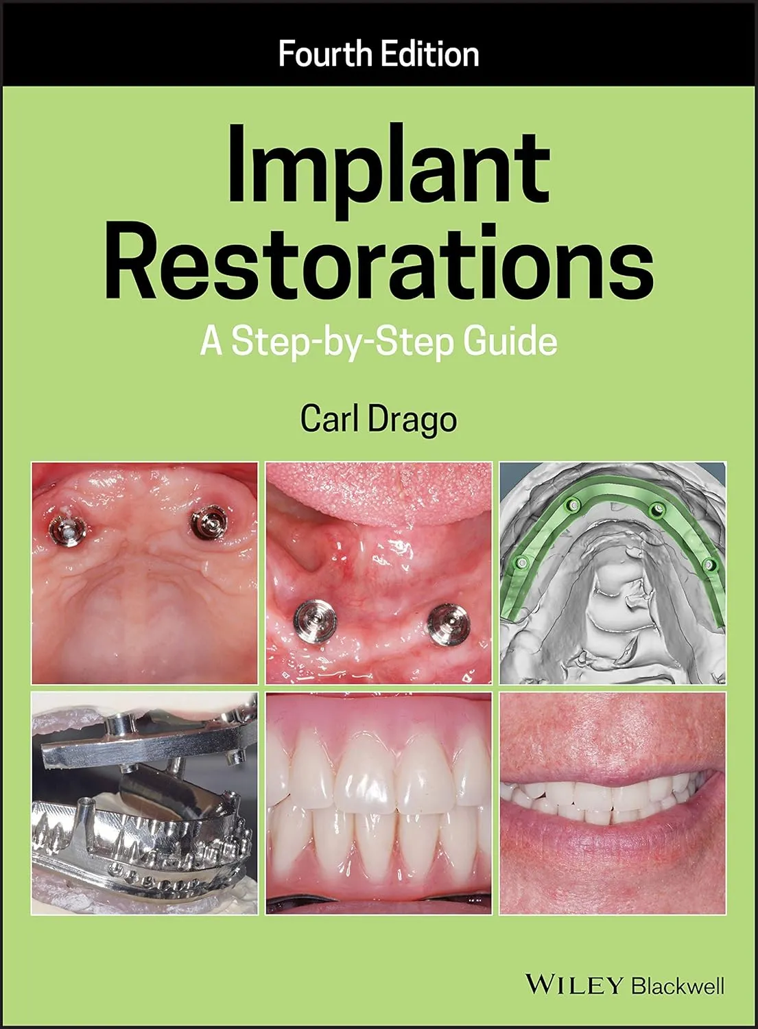Implant Restorations A Step By Step Guide 4th Edition | Hardcover