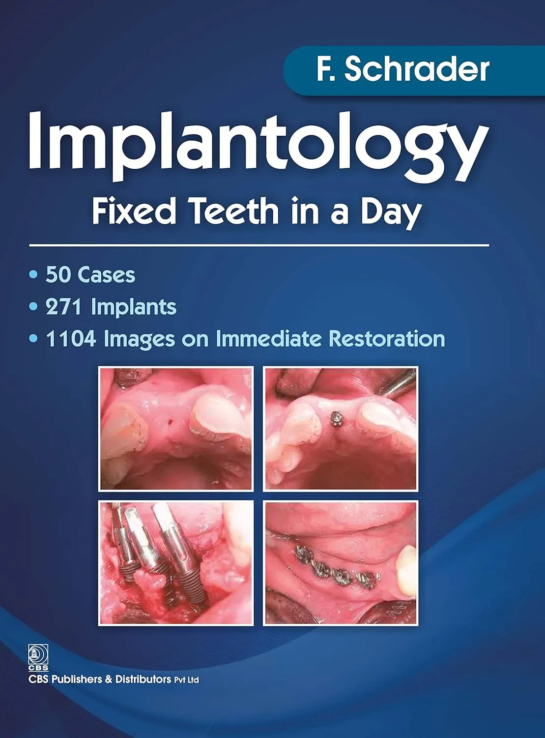 Implantology Fixed Teeth in a Day | Paperback