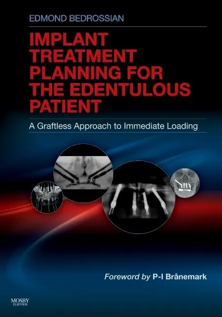Implants Treatment Planning for the edentulous Patient A Graftless Approach to Immediate Loading | Hardcover