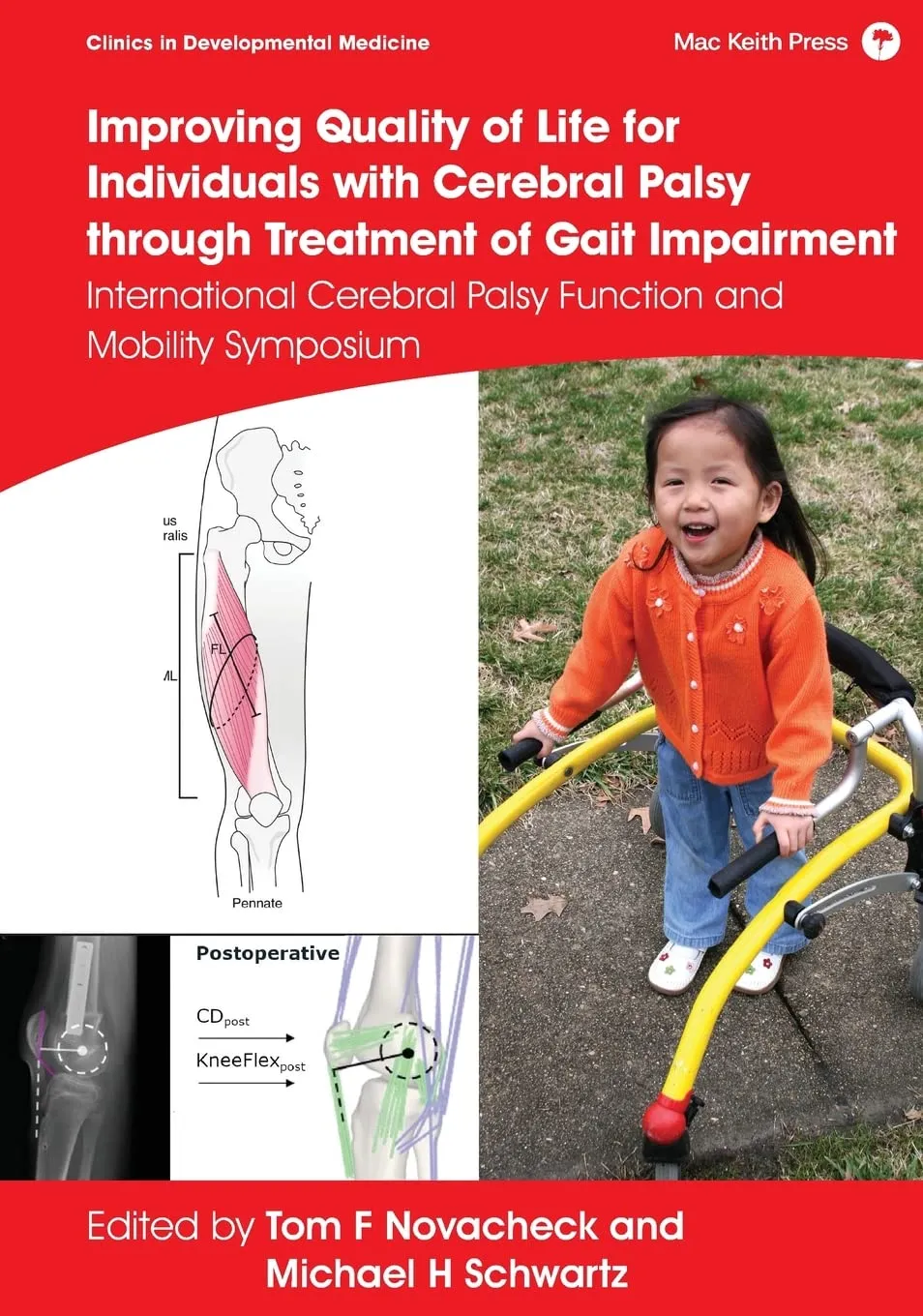 Improving Quality Of Life For Individuals With Cerebral Palsy Through Treatment Of Gait Impairment International Cerebral Palsy Function And Mobility | Hardcover