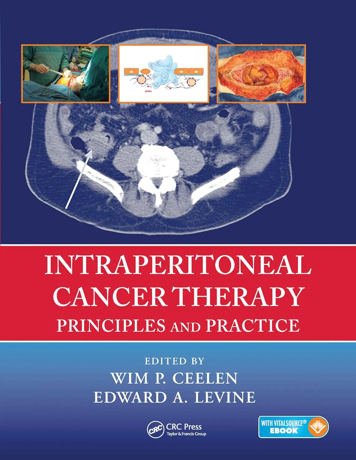 Intraperitoneal Cancer Therapy Principles And Practice | Paperback
