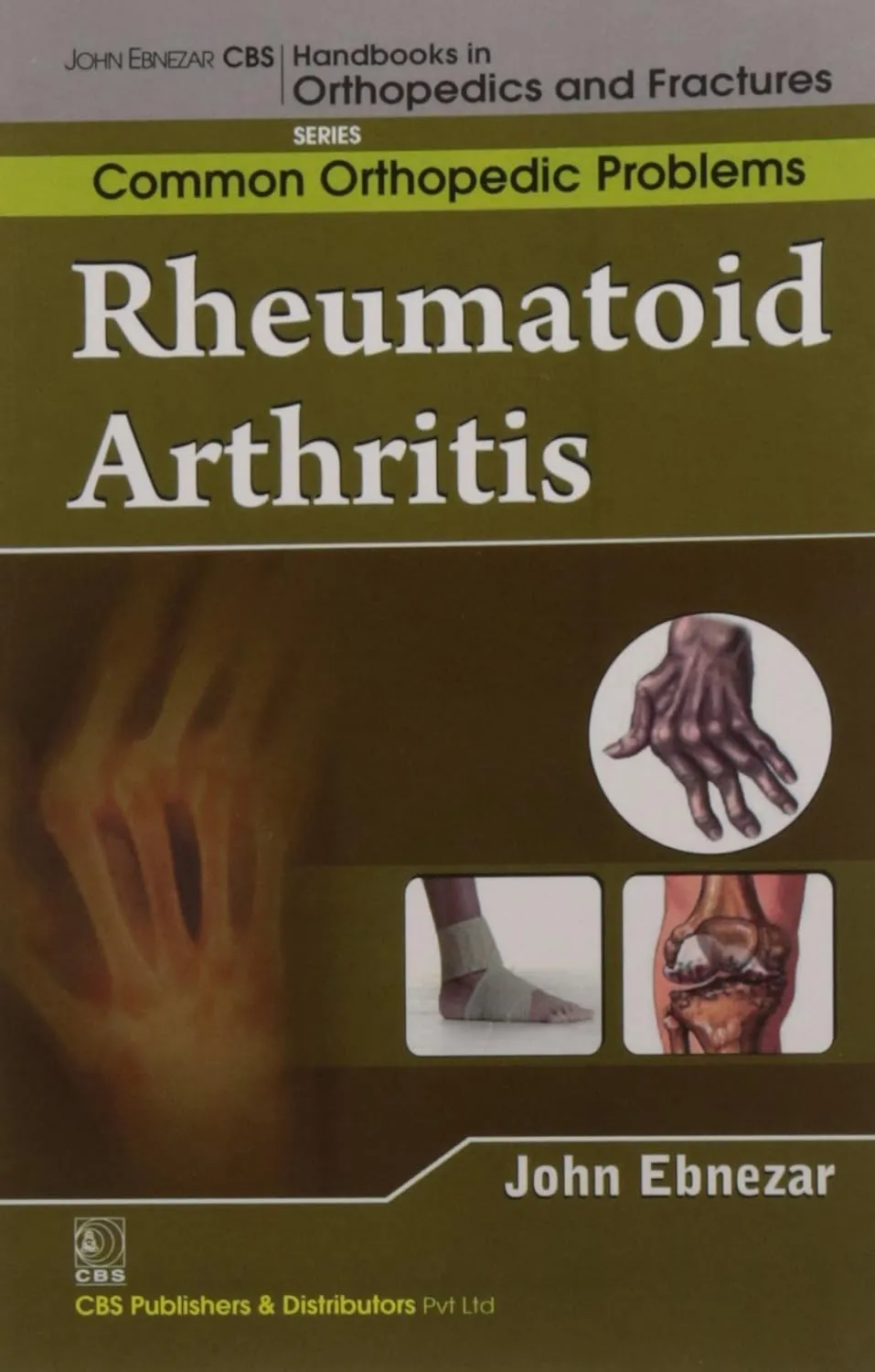 John Ebnezar CBS Handbooks in Orthopedics and Fractures Common Orthopedic Problems  Rheumatoid Arthritis