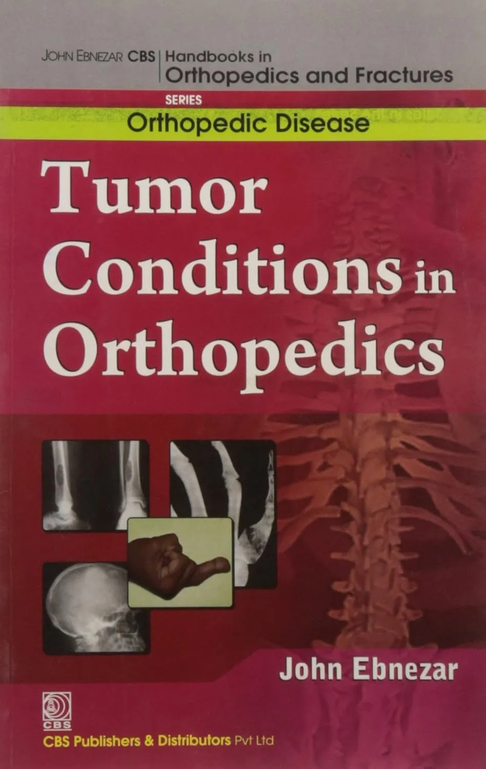 John Ebnezar CBS Handbooks in Orthopedics and Fractures Orthopedic Disease Tumor Conditions in Orthopedics