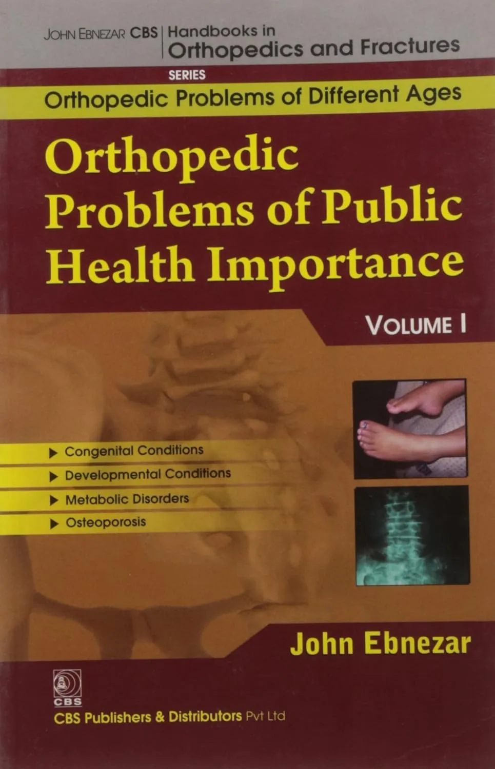 John Ebnezar CBS Handbooks in Orthopedics and Fractures Orthopedic Problems of Different Ages  Orthopedic Problems of Public Health Importance I