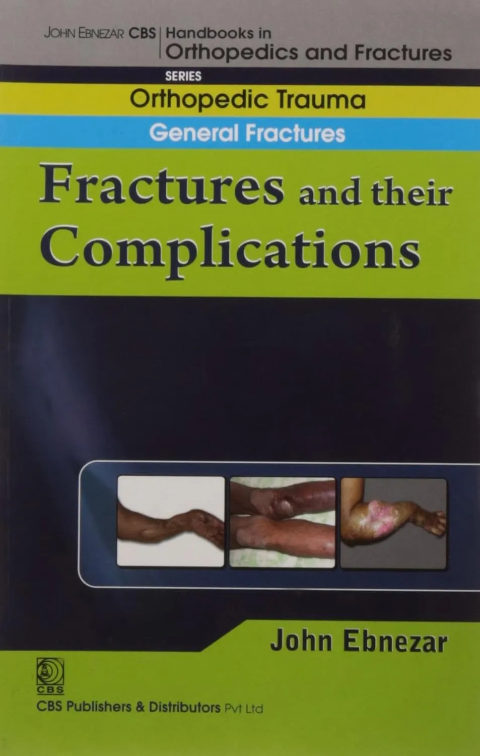 John Ebnezar CBS Handbooks in Orthopedics and Fractures Orthopedic Trauma General Fractures Fractures and their Complications