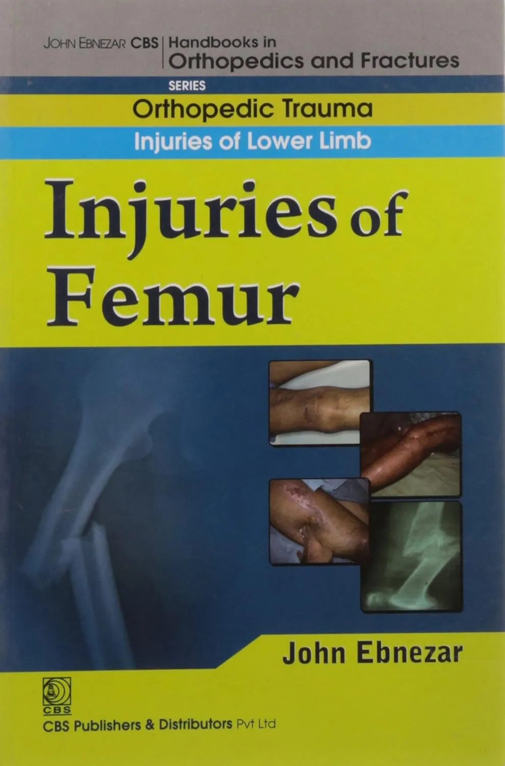 John Ebnezar CBS Handbooks in Orthopedics and Fractures Orthopedic Trauma Injuries of Lower Limb Injuries of Femur