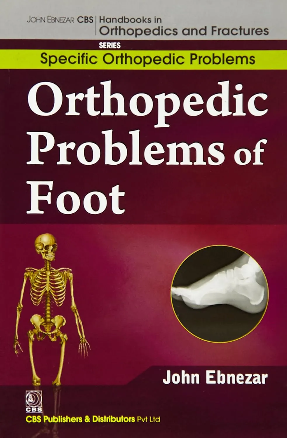 John Ebnezar CBS Handbooks in Orthopedics and Fractures Specific Orthopedic Problems Orthopedic Problems of Foot