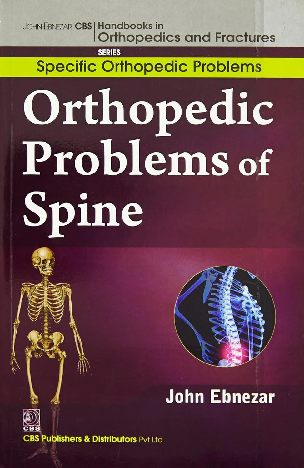 John Ebnezar CBS Handbooks in Orthopedics and Fractures Specific Orthopedic Problems Orthopedic Problems of Spine