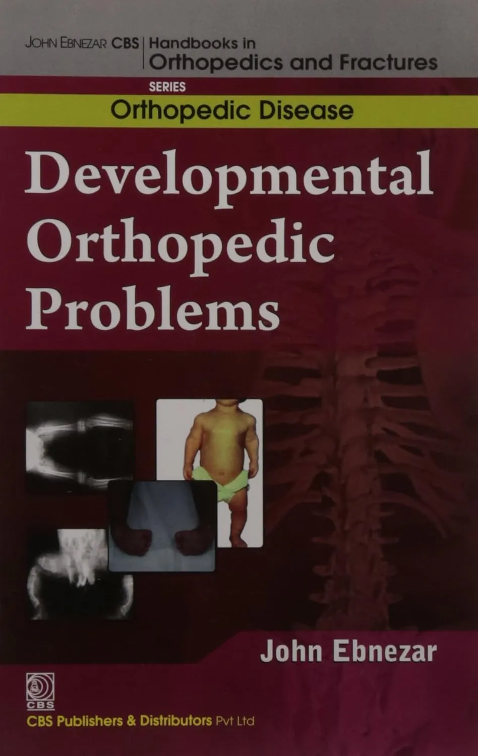 John Ebnezar Series | Developmental Orthopedic Problems