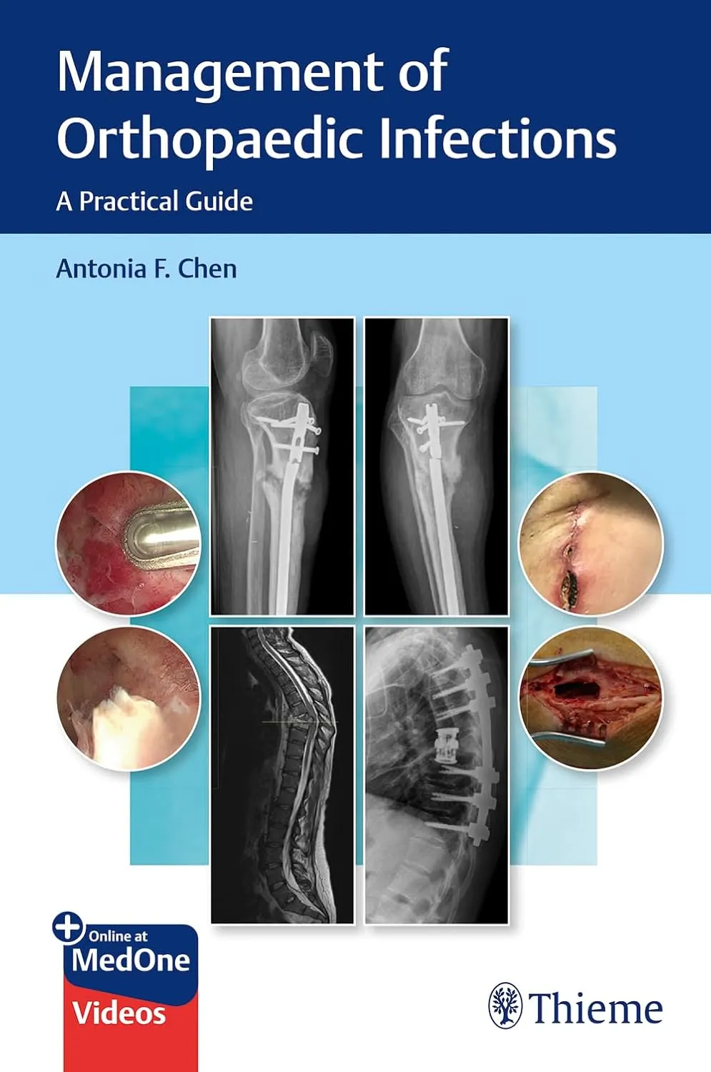 Management Of Orthopaedic Infections A Practical Guide With Access Code | Paperback