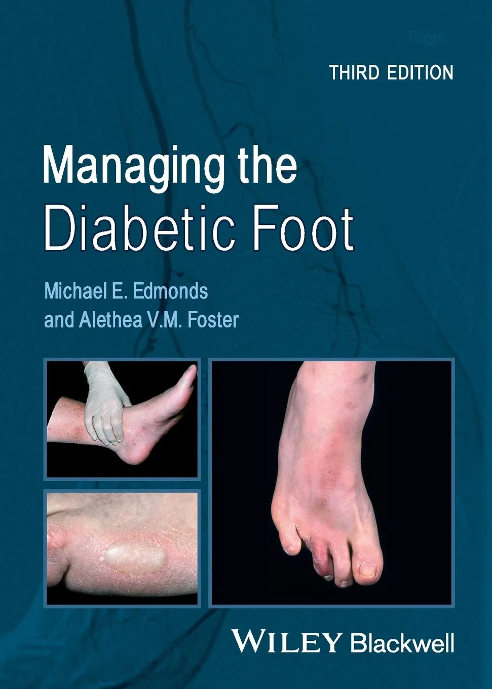 Managing the Diabetic Foot | Third Edition | Paperback