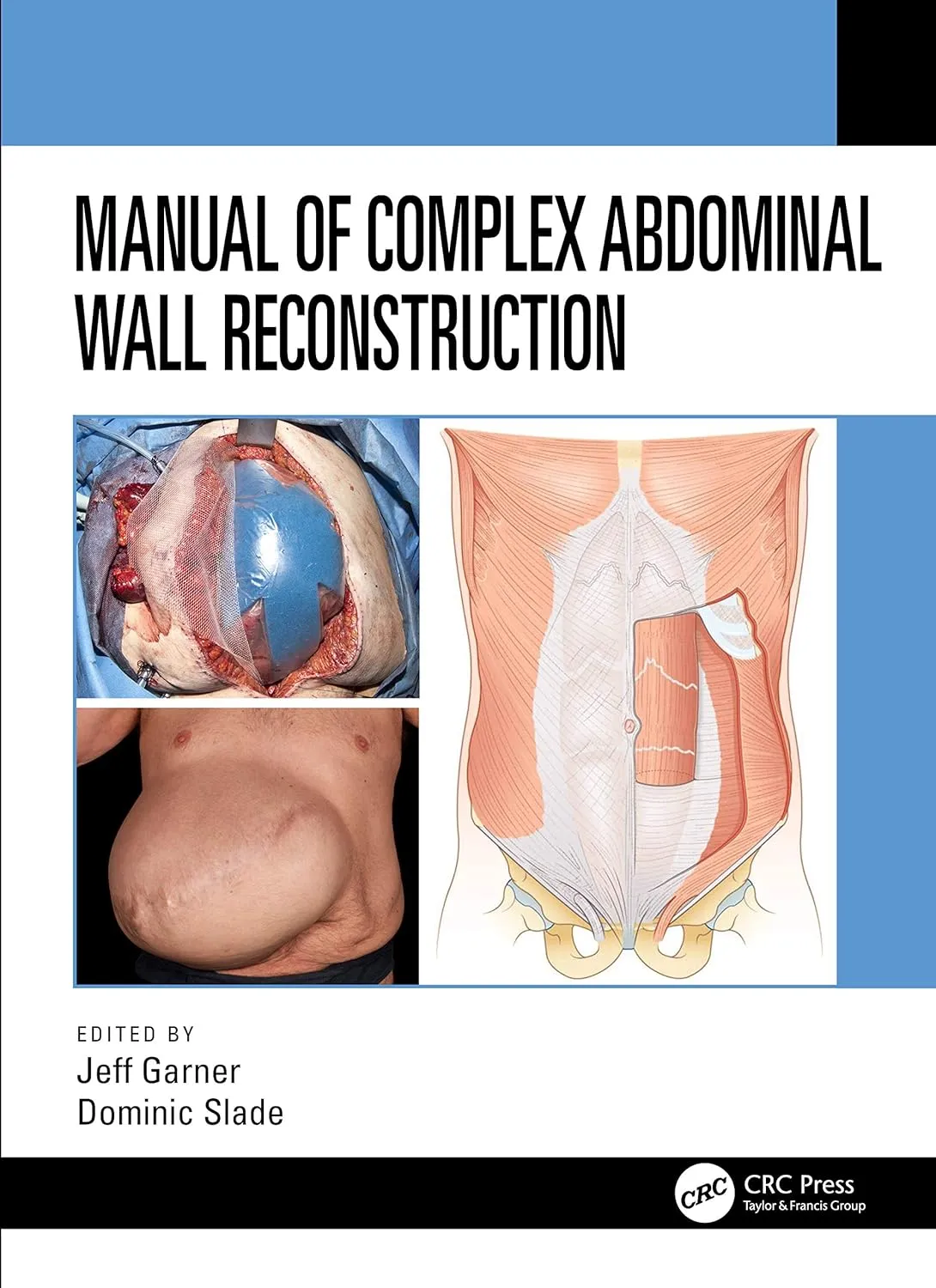 Manual Of Complex Abdominal Wall Reconstruction | Paperback