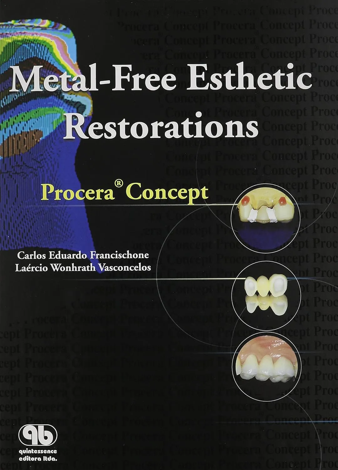 Metal-Free Esthetic Restorations Procera Concept | Hardcover