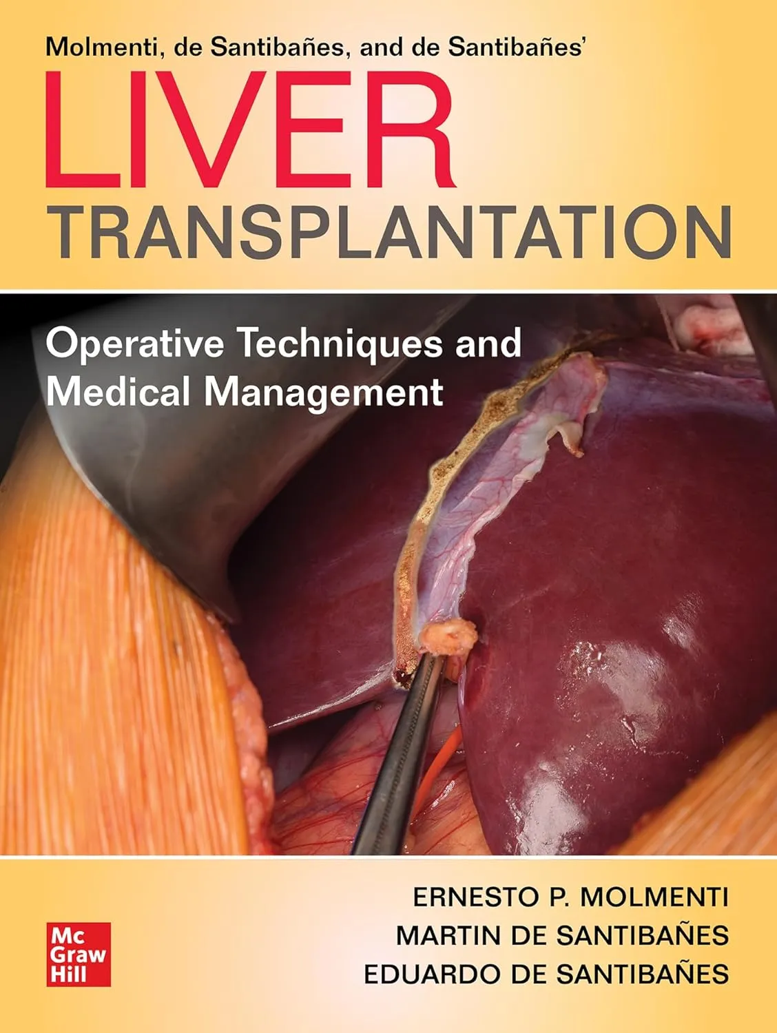 Molmenti De Santibanes And De Santibanes Liver Transplantation Operative Techniques And Medical Management | Hardcover