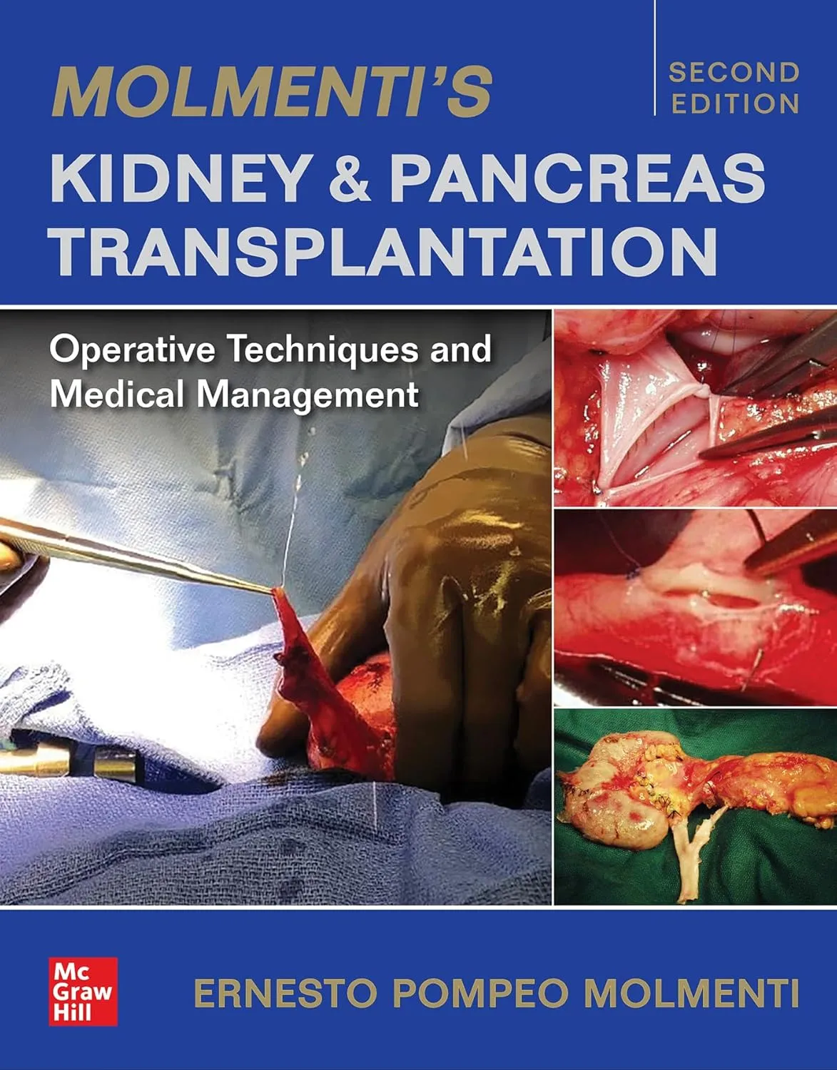 Molmentis Kidney And Pancreas Transplantation Operative Techniques And Medical Management 2nd Edition | Hardcover