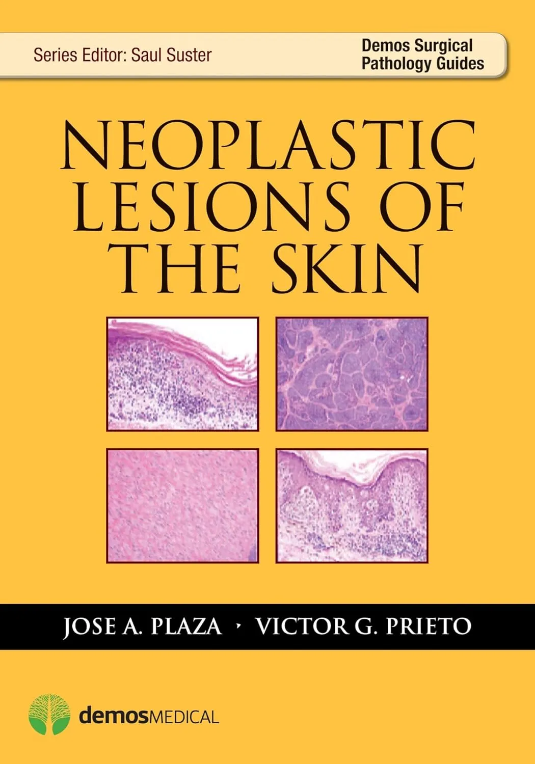 Neoplastic Lesions of the Skin | Paperback
