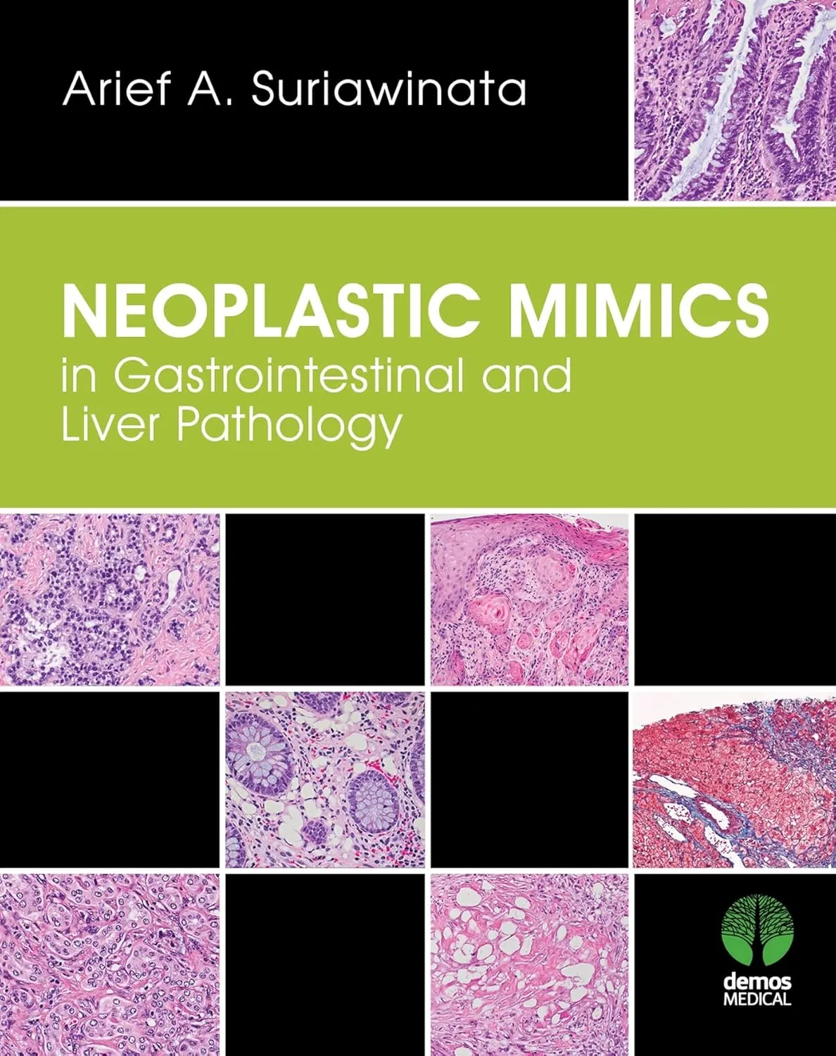 Neoplastic Mimics in Gastrointestinal and Liver Pathology | Hardcover