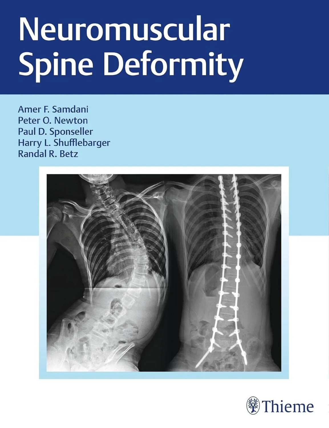 Neuromuscular Spine Deformity | Hardcover