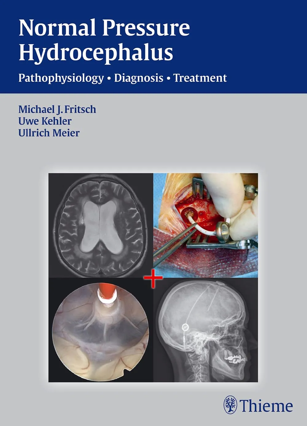 Normal Pressure Hydrocephalus Pathophysiology | Diagnosis | Treatment | Hardcover