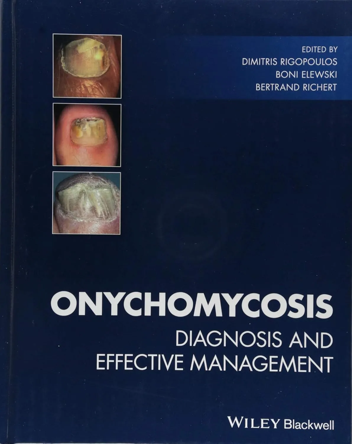 Onychomycosis Diagnosis and Effective Management | Hardcover