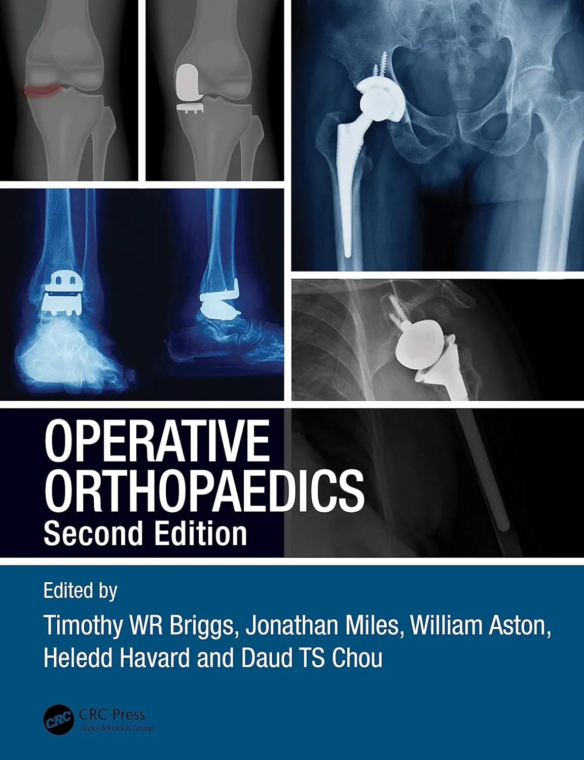 Operative Orthopaedics 2nd Edition | Paperback