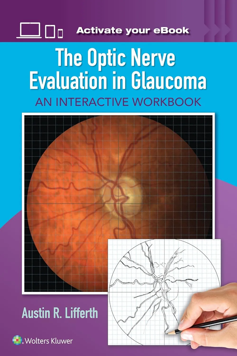 The Optic Nerve Evaluation in Glaucoma An Interactive Workbook | Paperback