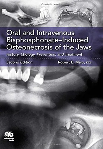 Oral and Intravenous Bisphosphonate-Induced Osteonecrosis of the Jaws | 2nd Edition | Paperback