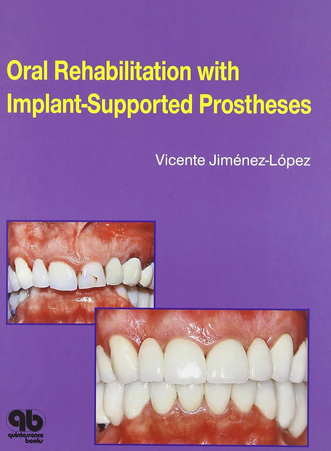Oral Rehabilitation with Implant-Supported Prostheses | Hardcover