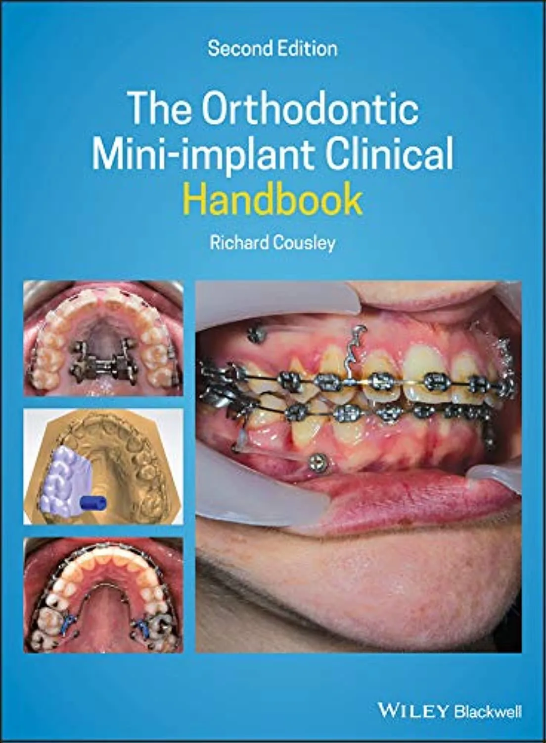 The Orthodontic Mini Implant Clinical Handbook 2nd Edition | Hardcover