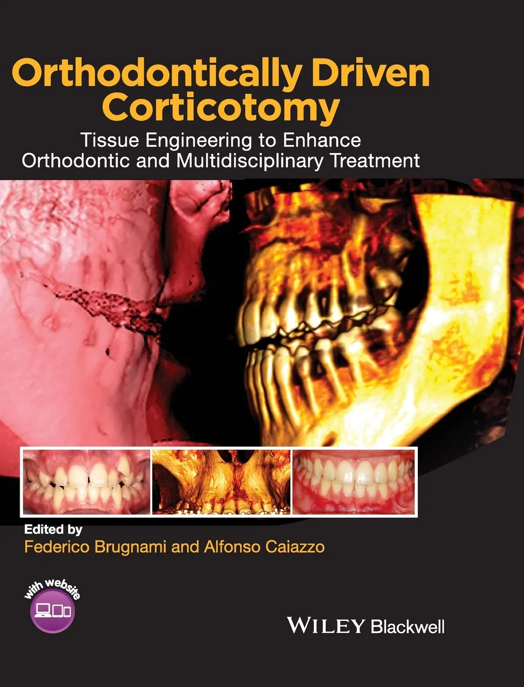 Orthodontically Driven Corticotomy | Hardcover