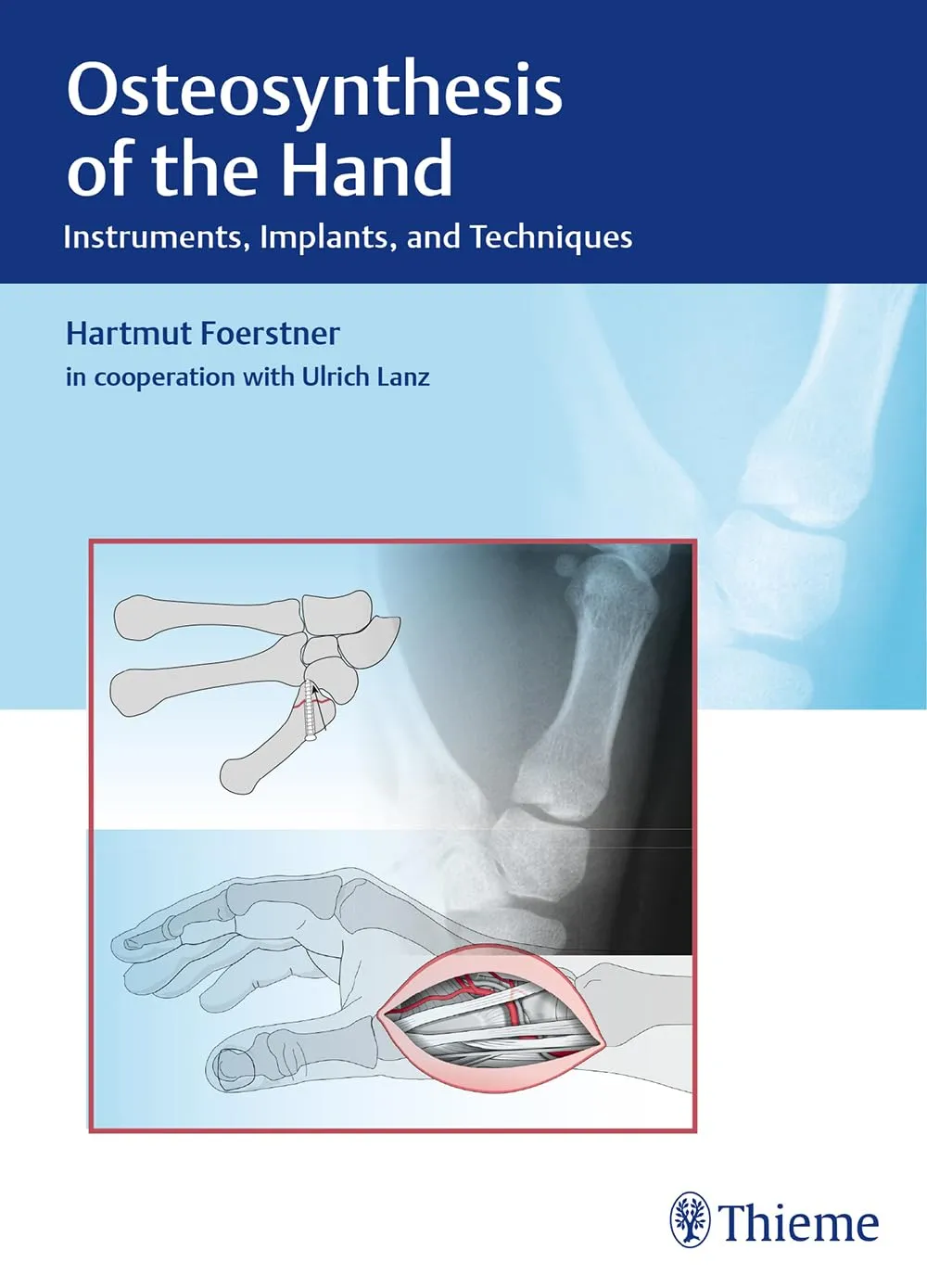 Osteosynthesis of the Hand | Hardcover