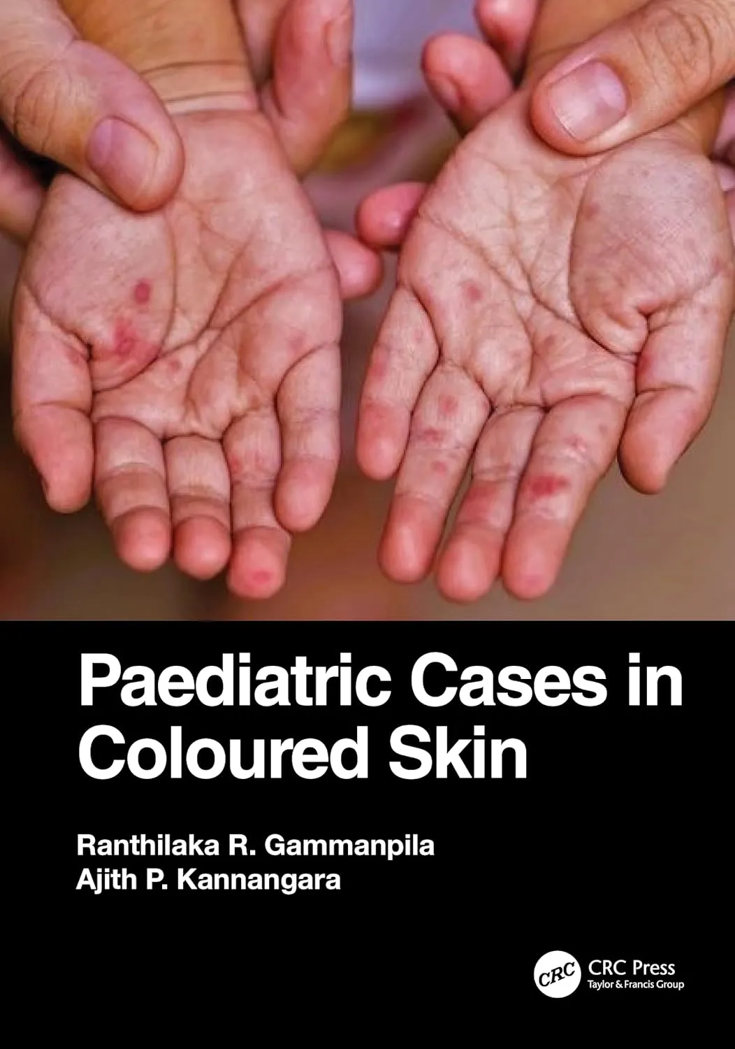 Paediatric Cases In Coloured Skin | Paperback
