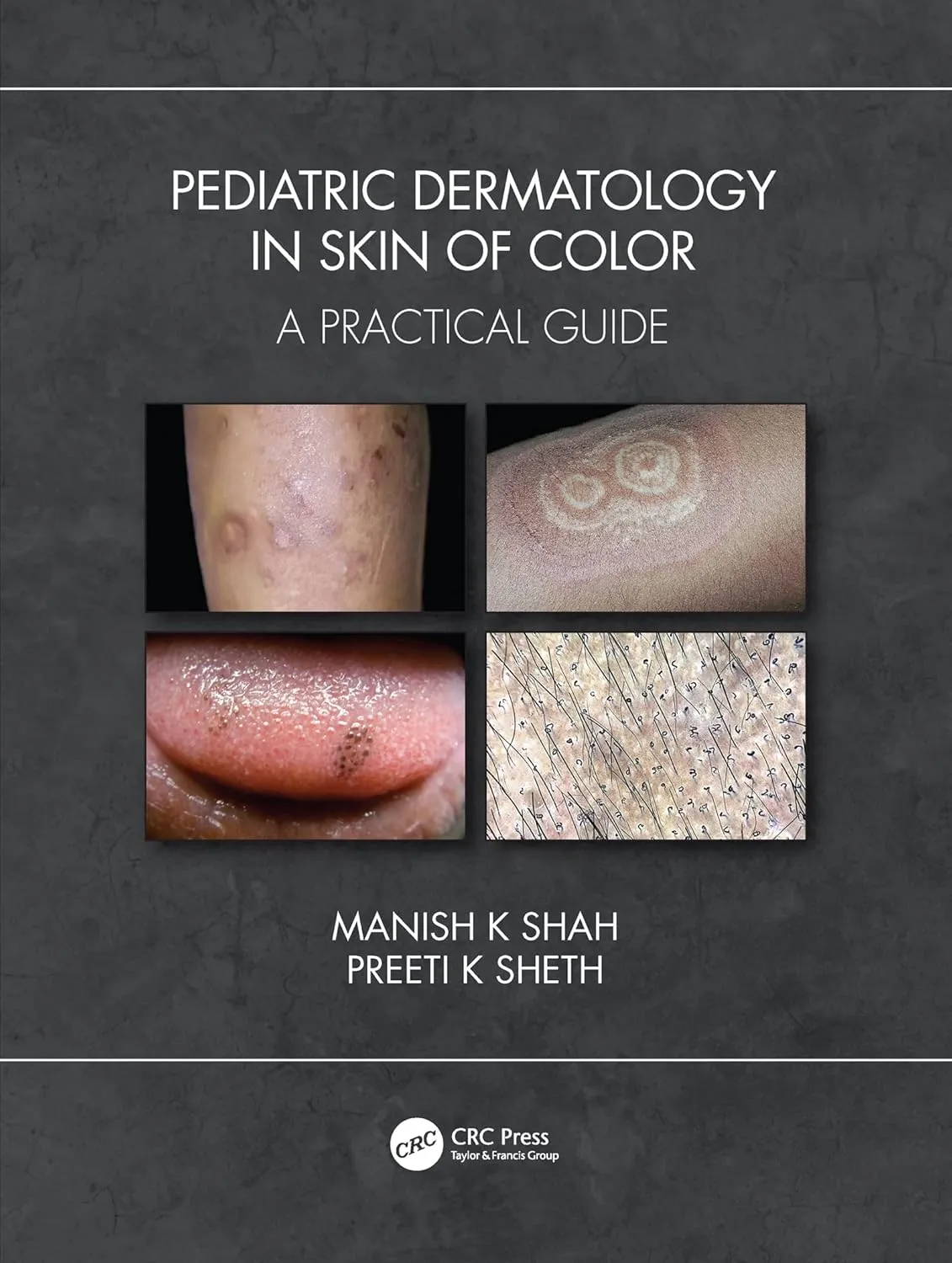 Pediatric Dermatology In Skin Of Color A Practical Guide | Paperback