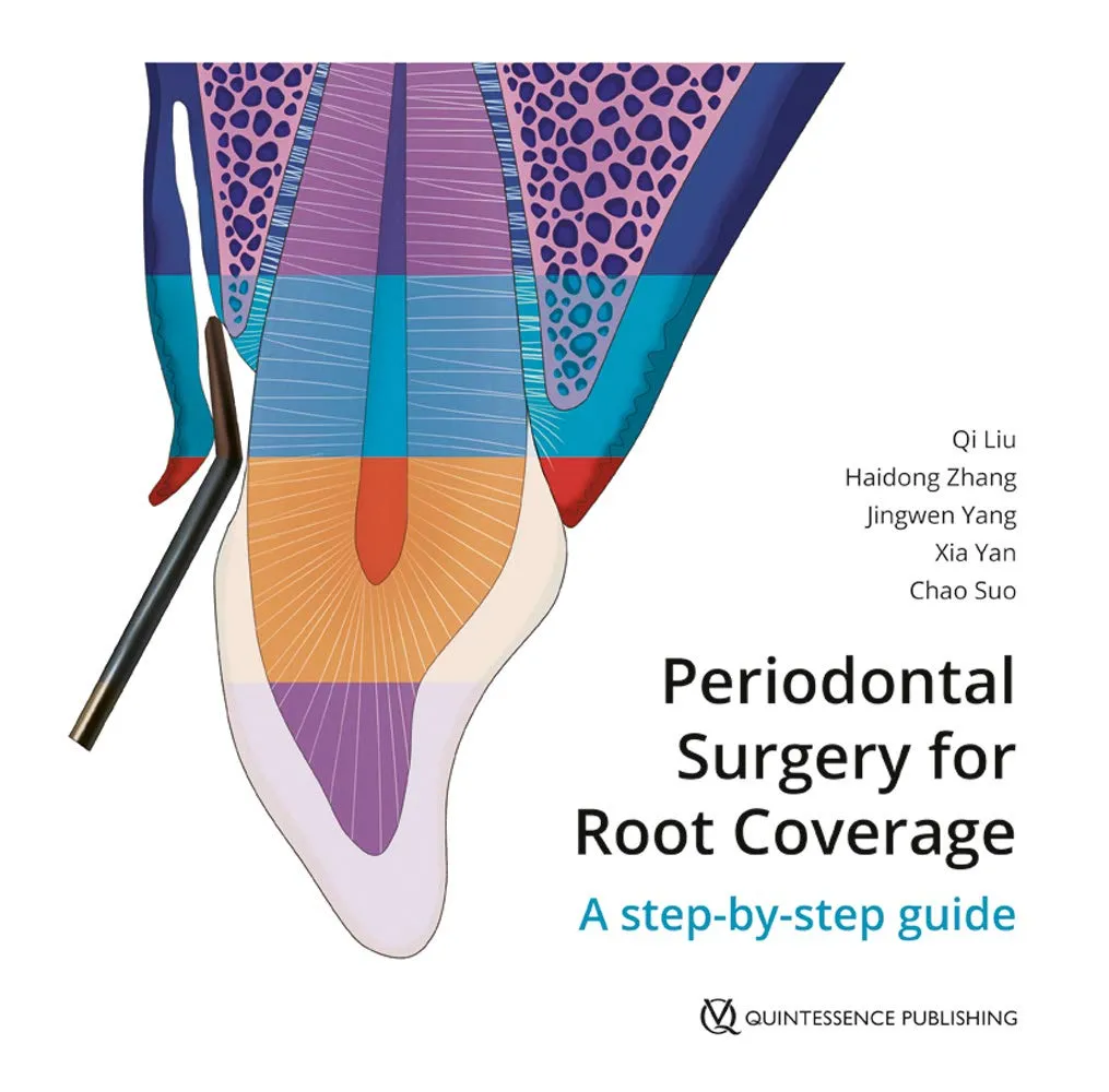 Periodontal Surgery for Root Coverage A Step-by-Step Guide | Hardcover