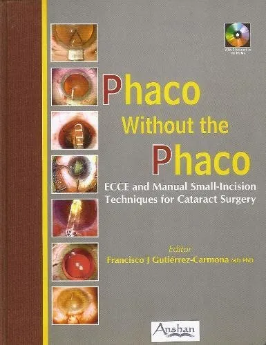 Phaco Without The Phaco